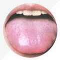 Enlarged tongue