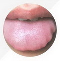 Tooth-marked tongue