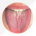 Cracked tongue