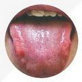 Tongue Dark Pale,with Purple Spots