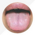 Pale Enlarged Tongue, Tongue coating white