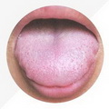Pale Enlarged Tongue,with tooth-mark