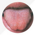 Deep Red Tongue,enlarged tongue