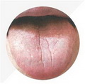 Pale Enlarged Tongue,tongue coating pale white