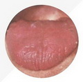 Tongue Proper Red,less tongue coating