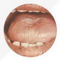 Pale Red Tongue,mirror-like tongue