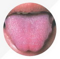 Purple tongue